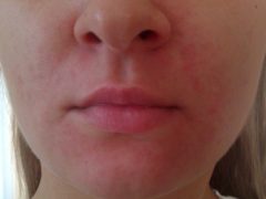 Как снять покраснение кожи лица: эффективное лечение и причины появления