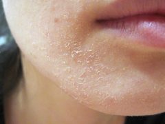Шелушится кожа на лице от мороза: что делать и как уберечь себя