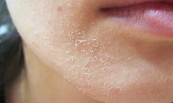 Шелушится кожа на лице от мороза: что делать и как уберечь себя