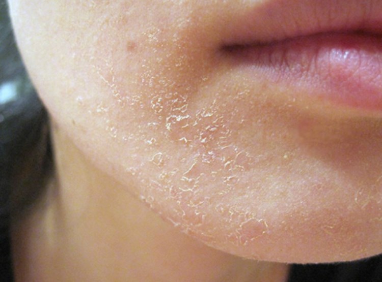 Что делать если шелушится кожа на лице после мороза