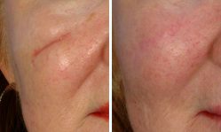 Крем от рубцов и шрамов на лице: как выбрать эффективное лечение