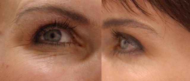 Маски от морщин вокруг глаз: эффективные рецепты после 30, 40 и 50 лет, готовим в домашних условиях