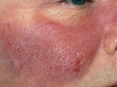 Воспаления на коже лица: эффективное лечение и определение причин