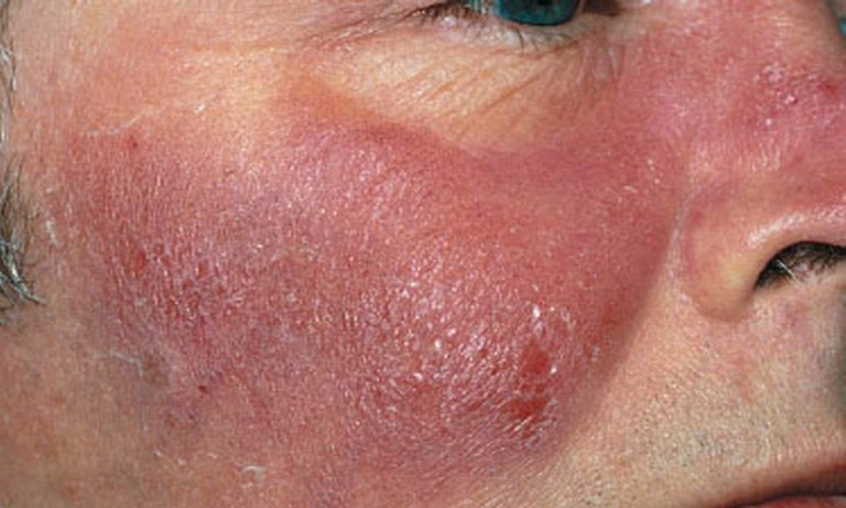 Частые воспаления на коже лица
