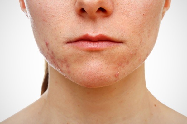 Лечение кожи лица после герпеса