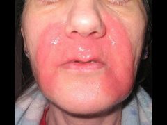 Ожоги на лице: правильное лечение