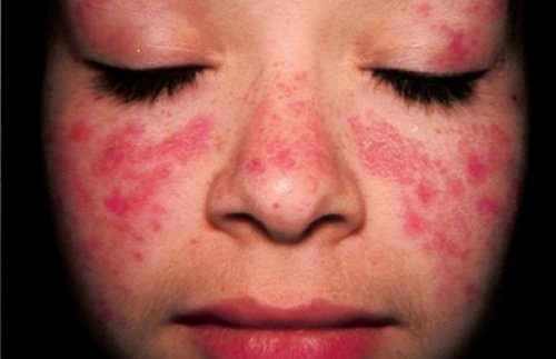Сыпь на лице от женских заболеваний