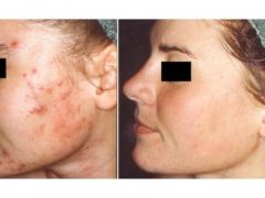 Гиперкератоз кожи лица: методики лечения, симптоматика, причины возникновения