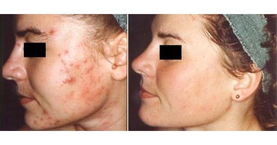 Гиперкератозы на коже лица
