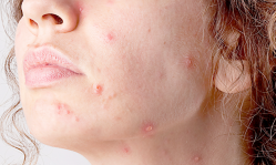 Кератоз кожи на лице: симптомы и методы лечения