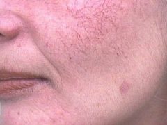 Купероз на лице: причины, методики лечения и профилактика