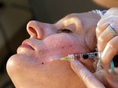 Биоармирование лица гиалуроновой кислотой: действенная техника омоложения