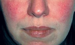 Краснота на лице: как избавиться, причины и эффективное лечение