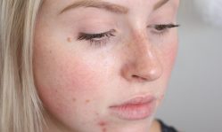 Демодекоз кожи лица: как эффективно вылечить