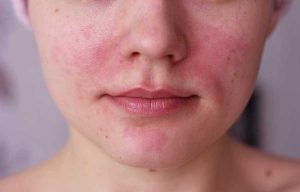 Гиперемия кожи лица губ
