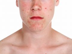 Лечение прыщей на лице у подростков: выбираем правильный способ
