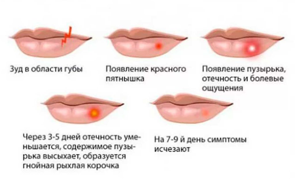 Герпес на губах: как лечить быстро
