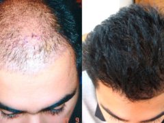 Восстановление волос и трансплантация: какая разница и что выбрать